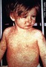 O Sarampo é uma doença de origem vírica que ataca principalmente crianças até 10 anos; esporadicamente ocorrem alguns casos em adultos. Os principais sintomas são: febre alta, tosse e vermelhidão por todo o corpo. </br></br> Palavras-chave: sarampo, vírus, doença.
