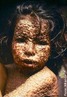 Classificada como uma das enfermidades mais devastadoras da histria da humanidade, a varola foi considerada erradicada pela Organizao Mundial de Sade (OMS) em 1980. A varola era uma doena infecto-contagiosa, exclusiva do homem (no sendo transmitida por outros animais, como a dengue, por exemplo), de surgimento e desenvolvimento repentinos e causada por um dos maiores vrus conhecidos e que  extremamente resistente aos agentes fsicos externos, como, por exemplo, variaes de umidade e temperatura. O vrus da varola pertence  famlia Poxviridae, a mesma dos vrus causadores de formas variantes da doena, prprias do gado bovino (a varola bovina), dos macacos, das galinhas e dos camelos. A transmisso ocorria de pessoa para pessoa por meio do convvio e geralmente pelas vias respiratrias. Uma vez dentro do organismo, o vrus da varola permanecia incubado de sete a 17 dias. A seguir, ele se estabelecia na garganta e nas fossas nasais e causava febre alta, mal-estar, dor de cabea, dor nas costas e abatimento, esse estado permanecia de dois a cinco dias. Finalmente, a enfermidade assumia sua forma mais violenta: a febre baixava e comeavam a aparecer erupes avermelhadas, que se manifestavam na garganta, boca, rosto e que depois espalhavam-se pelo corpo inteiro. Isso ocorre, porque o vrus da varola parasita as clulas do tecido epitelial para se reproduzir. Com o tempo, as erupes evoluam e transformavam-se em pstulas (pequenas bolhas cheias de pus), que provocavam coceira intensa e dor  era nesse estgio que o risco de cegueira era maior, pois, ao tocar o olho, o enfermo podia causar uma inflamao grave. </br></br> Palavras-chave: varola, vrus, feridas.