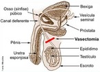	 É um procedimento em que os vasos deferentes (tubos que conectam os testículos ao pênis) são cortados. Assim a passagem dos espermatozóides produzidos pelos testículos é bloqueada. </br></br> Palavras-chave: vasectomia, deferentectomia, método contraceptivo, esterilização. 