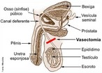 Vasectomia