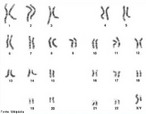 Cariótipo é o conjunto cromossômico ou a constante cromossômica diplóide (2n) de uma espécie. Representa o número total de cromossomos de uma célula somática (do corpo). Imagem de um cariótipo humano masculino. <br /><br /> Palavras-chave: cariótipo, conjunto cromossômico, cromossomo, genética.