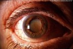 A catarata é uma lesão ocular que atinge e torna opaco o cristalino (lente situada atrás da íris cuja transparência permite que os raios de luz o atravessem e alcancem a retina para formar a imagem), o que compromete a visão. <br /><br /> Palavras-chave: catarata, cristalino, íris, retina, visão, sistema sensorial.