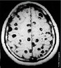 Ressonância magnética mostrando diversos cisticercos no cérebro humano – Trata-se de uma doença causada pela ingestão de ovos de <em>Taenia solium</em>. <br /><br /> Palavras-chave: <em>Taenia solium</em>, cisticercose, ressonância magnética.