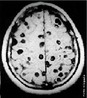 Ressonncia magntica mostrando diversos cisticercos no crebro humano  Trata-se de uma doena causada pela ingesto de ovos de <em>Taenia solium</em>. <br /><br /> Palavras-chave: <em>Taenia solium</em>, cisticercose, ressonncia magntica.