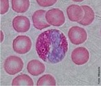 Granulócitos eosinófilos, geralmente chamados de eosinófilos (ou, menos comumente, acidófilos), são células do sistema imune responsáveis pela ação contra parasitas multicelulares e certas infecções nos vertebrados. Junto com os mastócitos, também controlam mecanismos associados com a alergia e asma. Desenvolvem-se na medula óssea (hematopoiese) antes de migrar para o sangue periférico. <br /><br /> Palavras-chave: eosinófilo, sangue, leucócitos, glóbulos brancos. 