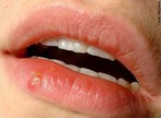 A herpes labial, também conhecida como herpes simples é uma doença infecciosa provocada por um vírus (DNA vírus) chamado herpes simplex vírus de tipo I (=HSV1). É caracterizada por uma erupção de vesículas cutâneas pequenas e geralmente dolorosas. </br></br> Palavras-chave: herpes labial, herpes oral, vírus. 