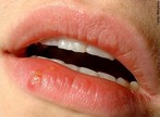 Herpes oral ou labial