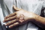 Leishmaniose cutânea é a forma mais comum de leishmaniose. Trata-se de uma infecção da pele causada por um parasita unicelular e transmitida por uma picada de Mosquito-palha. Há cerca de vinte espécies de Leishmania que podem causar leishmaniose cutânea. </br></br> Palavras-chave: leishmaniose, parasita, protozoário.