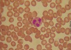 Os neutrófilos, também conhecidos como polimorfonucleares, são células sanguíneas leucocitárias responsáveis pela defesa do organismo, sendo sempre as primeiras a chegarem nas áreas de inflamação. Possuem um núcleo formado por dois a cinco lóbulos, sendo mais comuns três. Quando está célula é jovem, possui um núcleo não-segmentado em lóbulos, passando a receber o nome de bastonete (nesta fase, o formato do núcleo assemelha-se a um bastonete curvo). </br></br> Palavras-chave: neutrófilos, sangue, leucócitos, glóbulos brancos. 