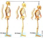 Osteoporose  a doena ssea metablica mais freqente, sendo a fratura a sua manifestao clnica.  definida patologicamente como "diminuio absoluta da quantidade de osso e desestruturao da sua microarquitetura levando a um estado de fragilidade em que podem ocorrer fraturas aps traumas mnimos".  considerada um grave problema de sade pblica, sendo uma das mais importantes doenas associadas com o envelhecimento. </br></br> Palavras-chave: osteoporose, diagnstico, sintomas.