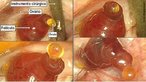 As fotos do momento em que um óvulo se desprende do ovário foram feitas durante uma cirurgia de histectomia, pelo ginecologista Jacques Donnez. O oócito, ou óvulo, pertence a uma mulher belga de 45 anos. Nas imagens, é possível ver o óvulo emergindo do folículo, um saco vermelho cheio de fluidos localizado nos ovários (área clara). Ao ser expelido, o óvulo vem envolvido em uma espécie de gelatina amarela contendo células. Ele então entra nas Tubas uterinas e é levado até o útero. </br></br> Palavras-chave: ovulação, óvulo, ovário.