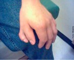 A polidactilia é uma anomalia causada pela manifestação de um alelo autossômico dominante com penetrância incompleta, consistindo na alteração quantitativa anormal dos dedos da mão (quirodáctilos) ou dos dedos do pé (pododáctilos). Há uma variação muito grande na expressão dessa característica, desde a presença de um dedo extra, completamente desenvolvido, até a de uma simples profusão carnosa. </br></br> Palavras-chave: polidactilia, mutação, genética, mão, pé. 